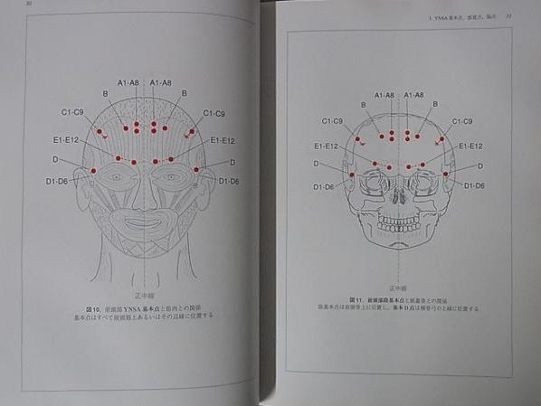 YNSA 山元式頭針療法